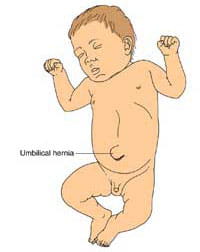 side effects of belly button hernia